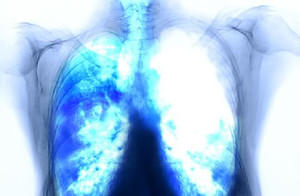 life insurance with sarcoidosis